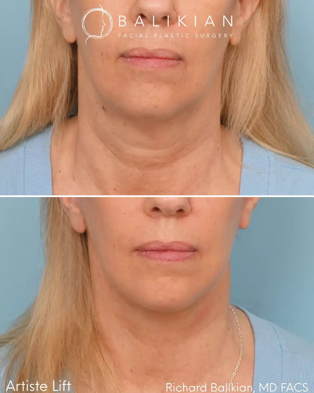 Before and after Deep Vertical Neck Lift with the Artiste Lift™ Preservation Deep Plane Facelift in a 59-year-old woman showing a smoother neck, sharper jawline, and natural facial rejuvenation.