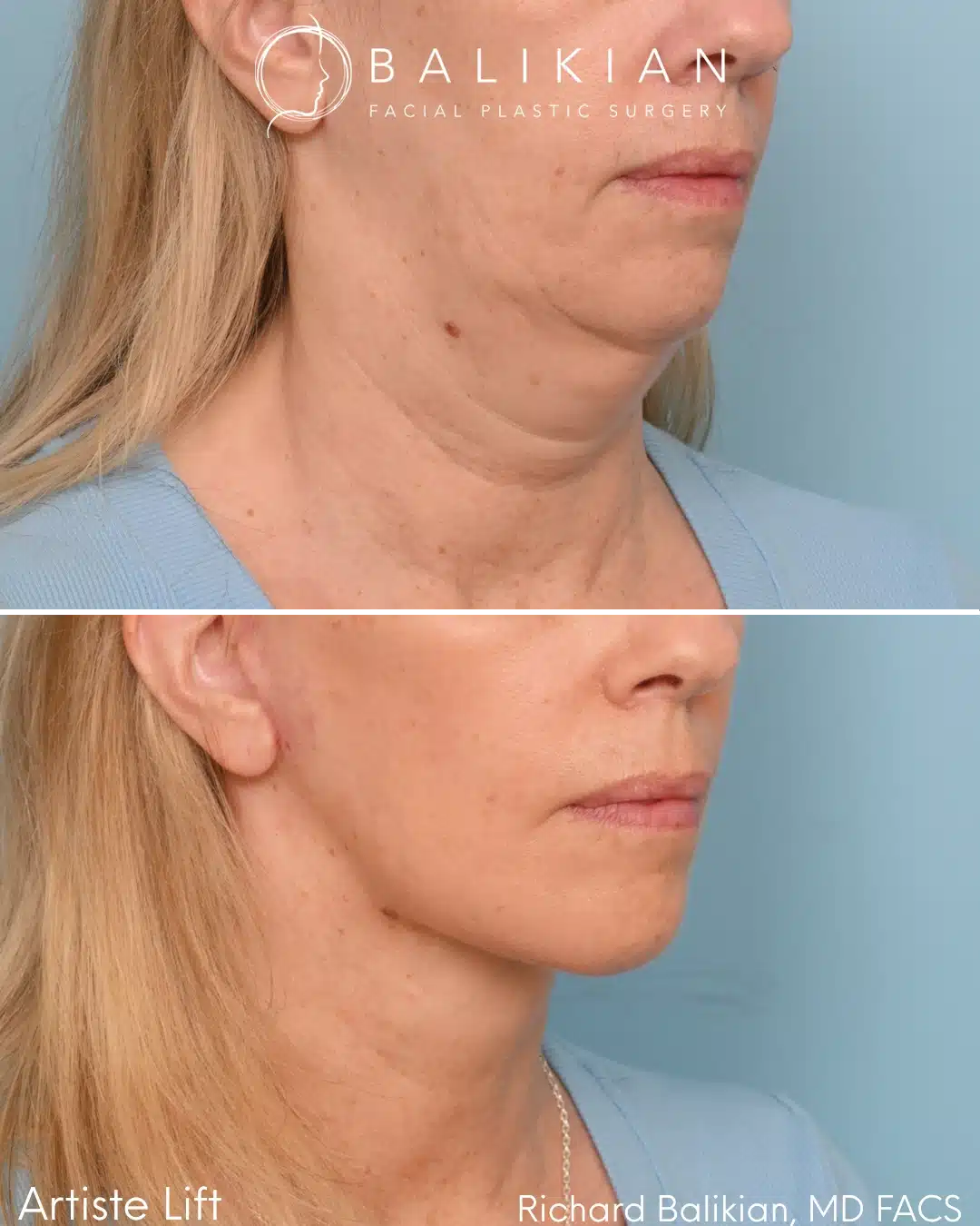 Before and after Deep Vertical Neck Lift with the Artiste Lift™ Preservation Deep Plane Facelift in a 59-year-old woman showing a smoother neck, sharper jawline, and natural facial rejuvenation.