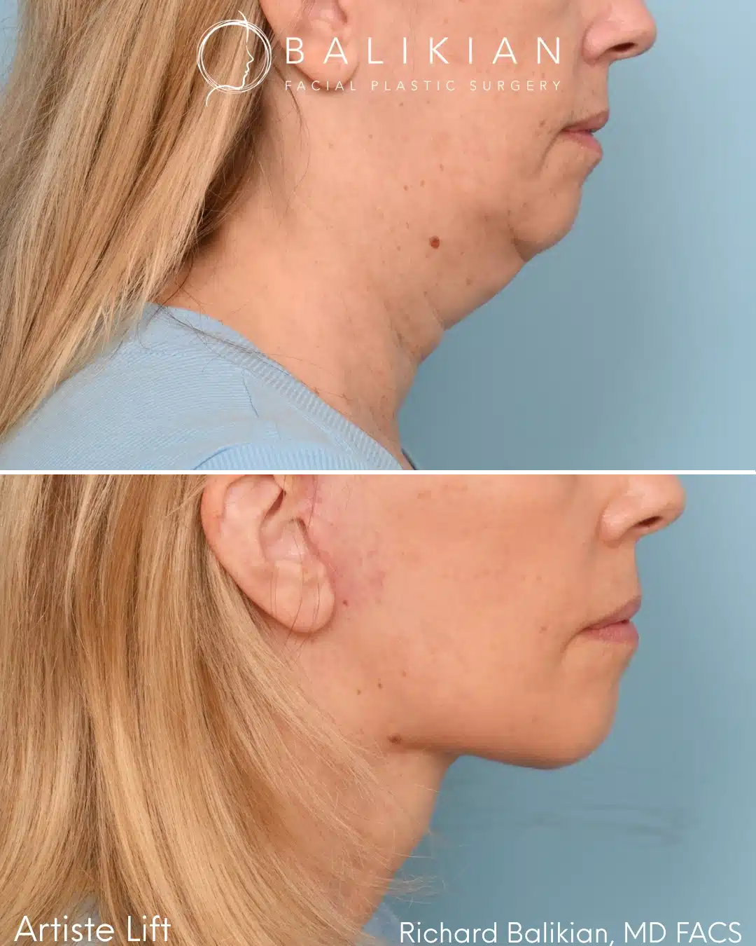 Before and after Deep Vertical Neck Lift with the Artiste Lift™ Preservation Deep Plane Facelift in a 59-year-old woman showing a smoother neck, sharper jawline, and natural facial rejuvenation.