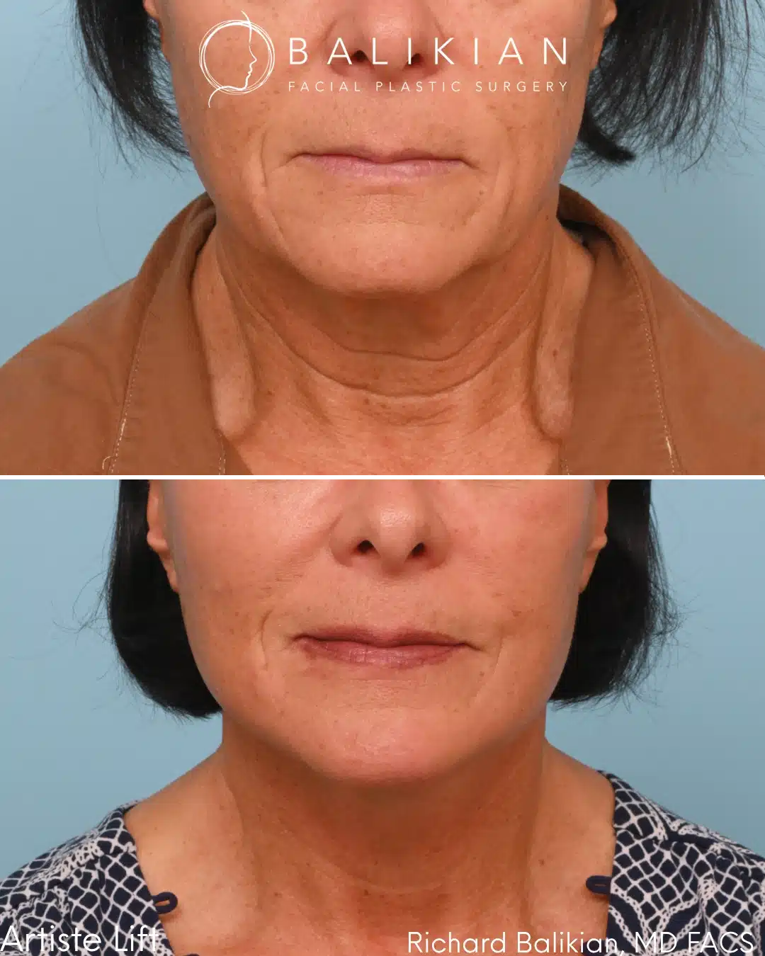 Before and after Deep Vertical Neck Lift with the Artiste Lift™ Preservation Deep Plane Facelift in a 61-year-old woman showing a smoother neckline, improved jawline definition, and natural facial rejuvenation.