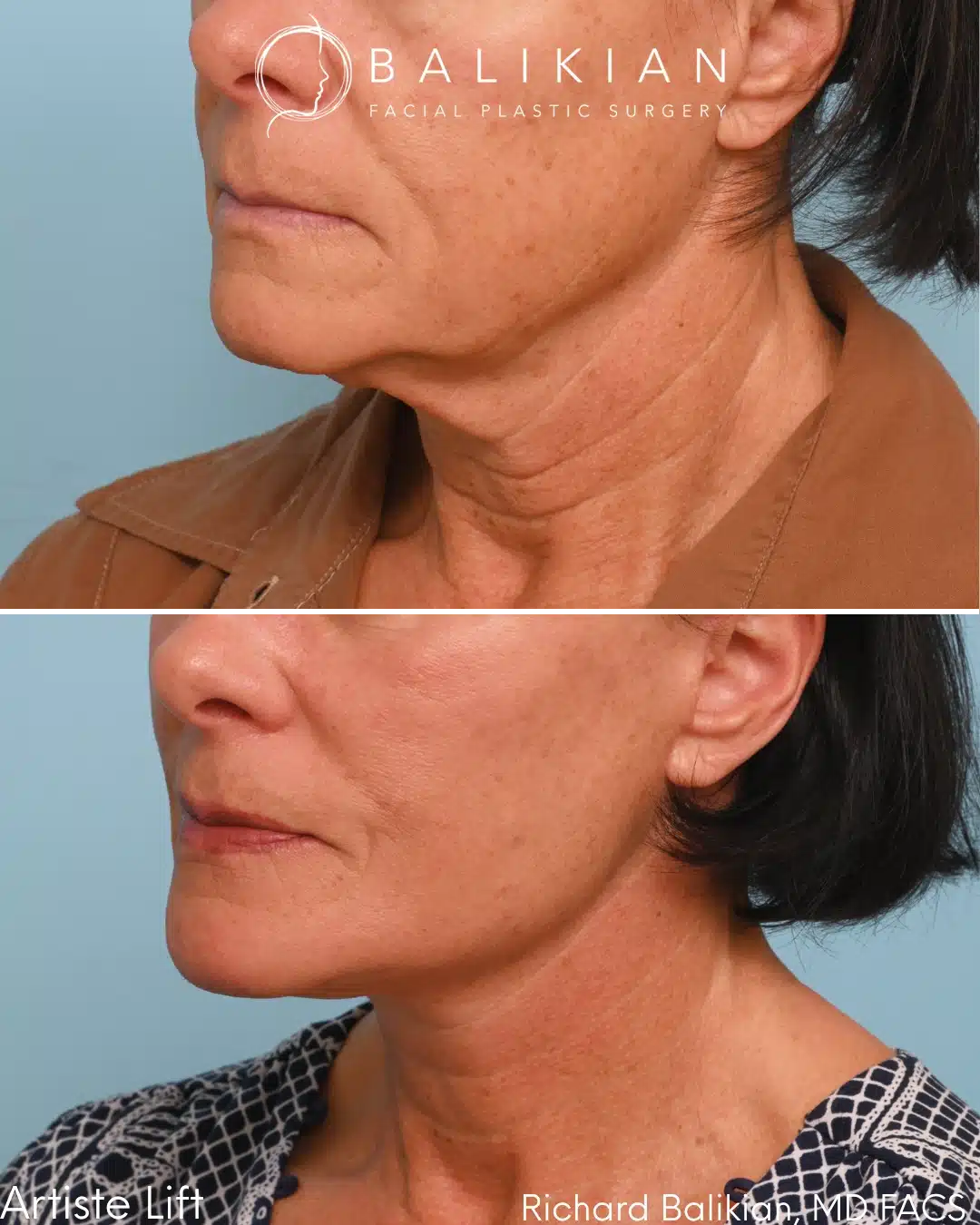 Before and after Deep Vertical Neck Lift with the Artiste Lift™ Preservation Deep Plane Facelift in a 61-year-old woman showing a smoother neckline, improved jawline definition, and natural facial rejuvenation.