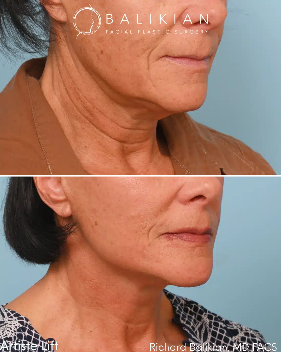 Before and after Deep Vertical Neck Lift with the Artiste Lift™ Preservation Deep Plane Facelift in a 61-year-old woman showing a smoother neckline, improved jawline definition, and natural facial rejuvenation.