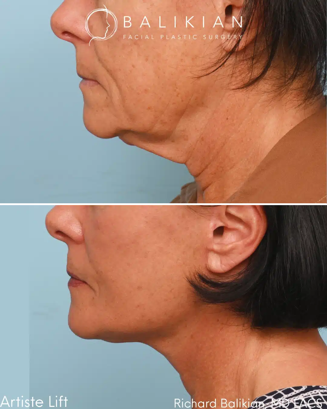 Before and after Deep Vertical Neck Lift with the Artiste Lift™ Preservation Deep Plane Facelift in a 61-year-old woman showing a smoother neckline, improved jawline definition, and natural facial rejuvenation.