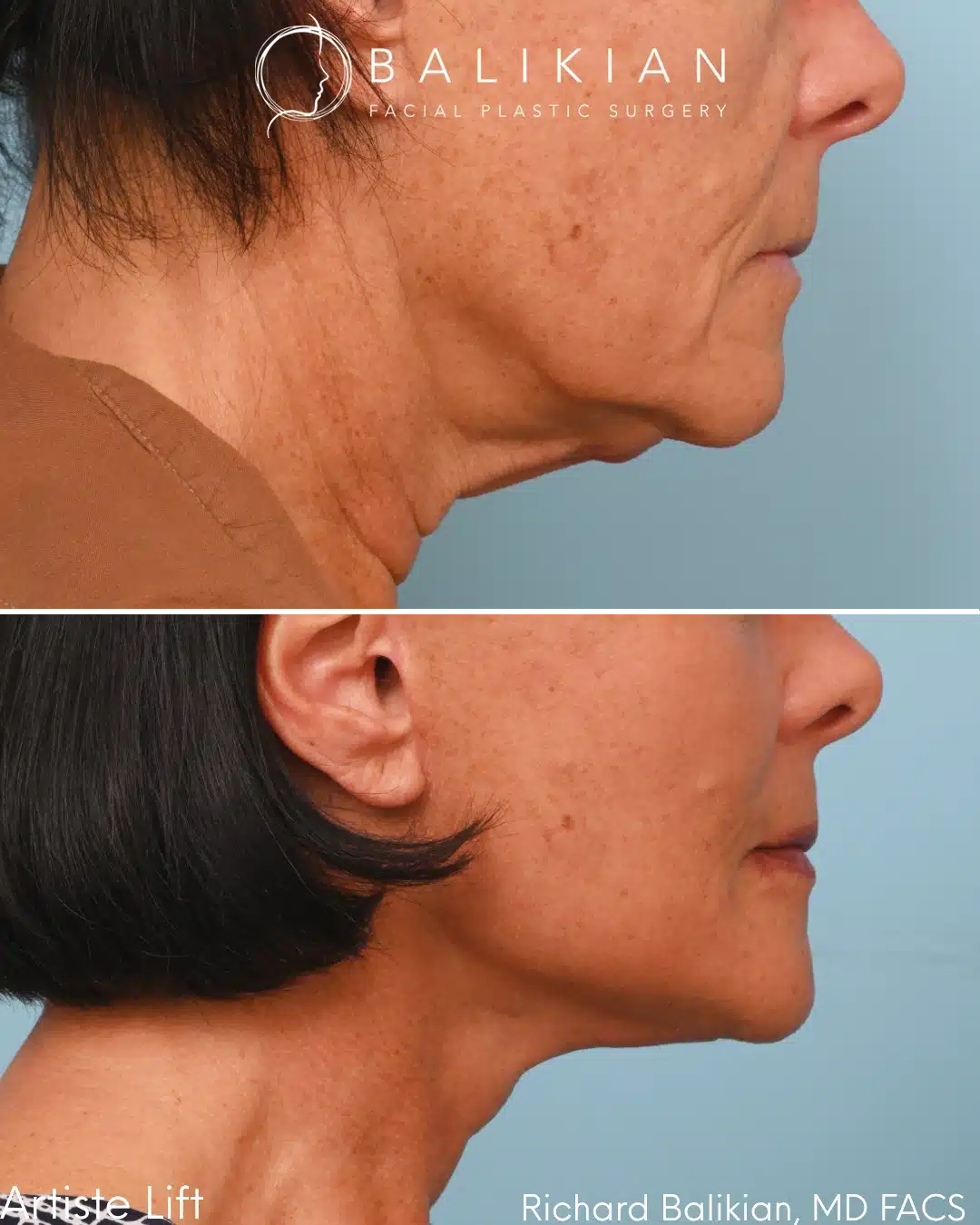 Before and after Deep Vertical Neck Lift with the Artiste Lift™ Preservation Deep Plane Facelift in a 61-year-old woman showing a smoother neckline, improved jawline definition, and natural facial rejuvenation.