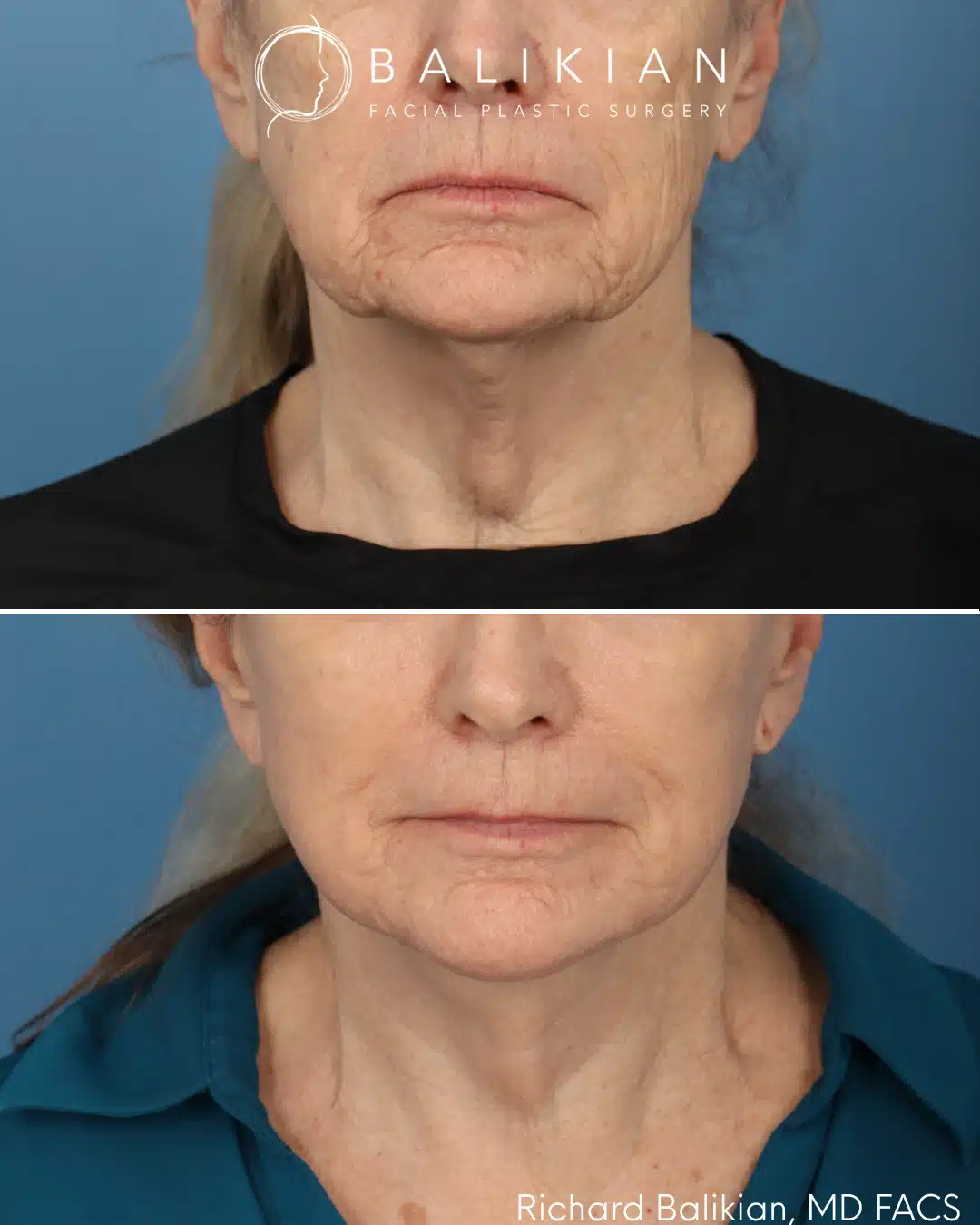 Before and after Deep Vertical Neck Lift with the Artiste Lift™ Preservation Deep Plane Facelift in a 71-year-old woman showing improved neck contour, a more defined jawline, and a naturally refreshed appearance.