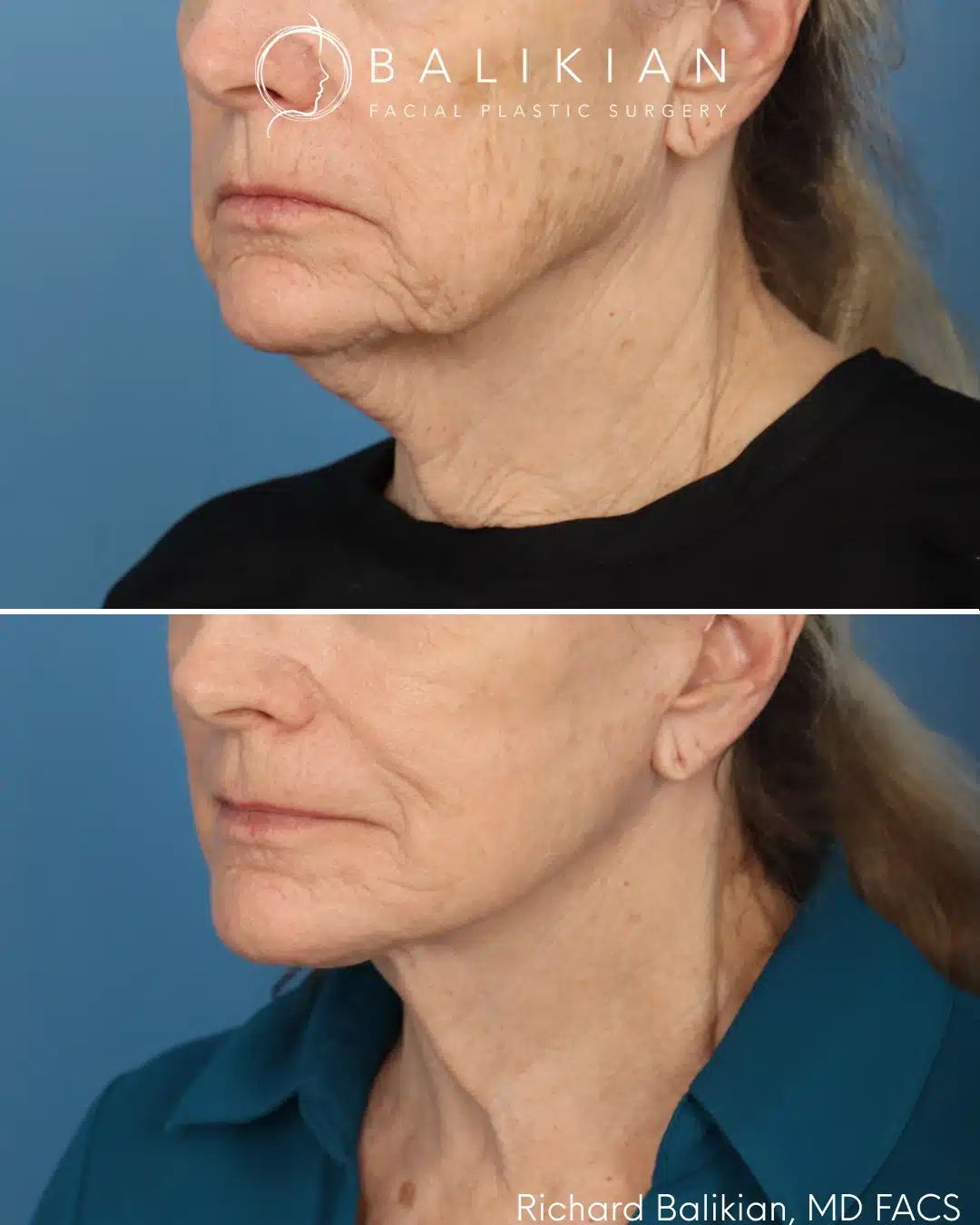 Before and after Deep Vertical Neck Lift with the Artiste Lift™ Preservation Deep Plane Facelift in a 71-year-old woman showing improved neck contour, a more defined jawline, and a naturally refreshed appearance.