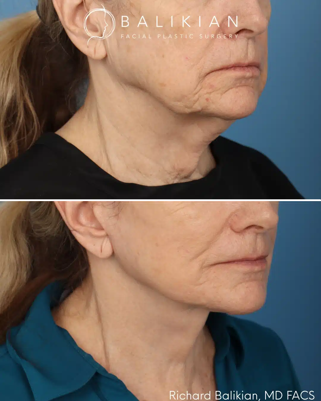 Before and after Deep Vertical Neck Lift with the Artiste Lift™ Preservation Deep Plane Facelift in a 71-year-old woman showing improved neck contour, a more defined jawline, and a naturally refreshed appearance.