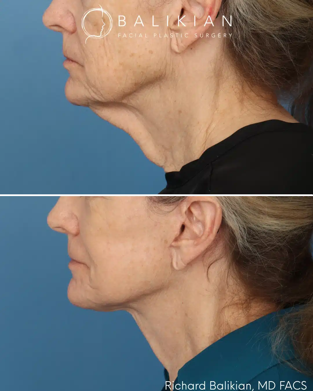 Before and after Deep Vertical Neck Lift with the Artiste Lift™ Preservation Deep Plane Facelift in a 71-year-old woman showing improved neck contour, a more defined jawline, and a naturally refreshed appearance.